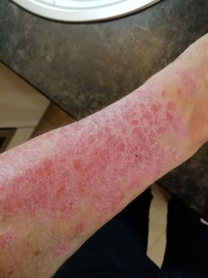 Neurodermatitis CDL Dec 2025.jpg