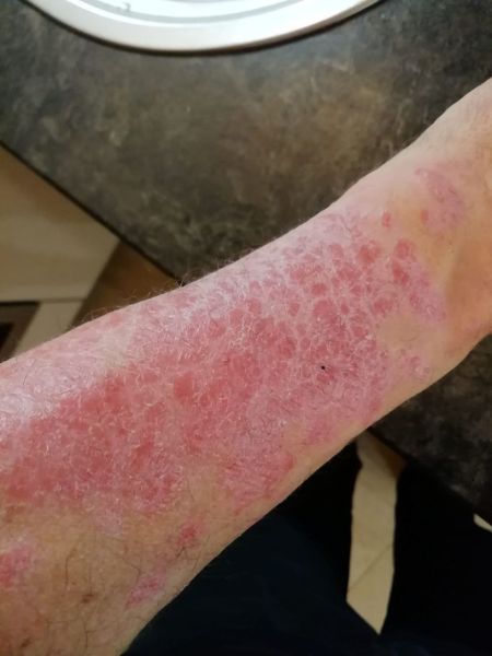 File:Neurodermatitis CDL Dec 2025.jpg