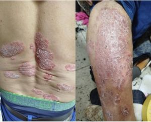 Psoriasis 15Years CD S 01.jpg