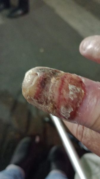 File:DiabeticFinger 2.jpg
