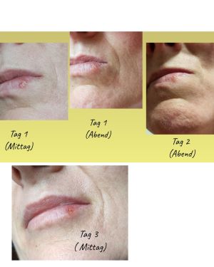 Cold Sore Herpes CDL 3Days.jpg