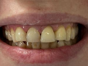Dental Reimplant Trauma 4.jpg