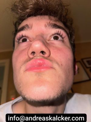CFS CDS Lip Before.jpg