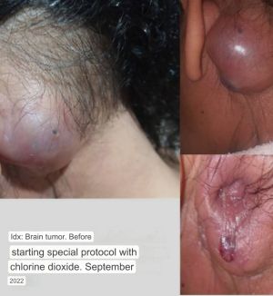 Brain Tumor Before After.jpg
