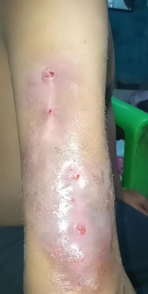 Case study severe osteomyeliti 4.jpg
