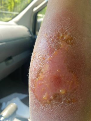Brown Recluse Metal Implants 02.jpg