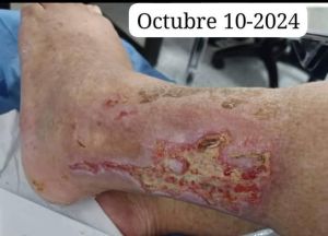 Diabetic Non Healing Wound CDS DMSO Moringa 01.jpg