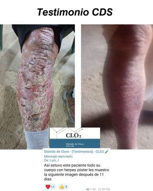 Herpes Zoster Before After.jpg