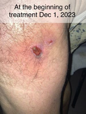Case study hyperkeratosis pust 2.jpg