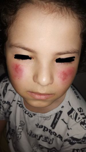 Child Facial Dermatitis CDS 01.jpg