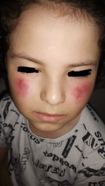 File:Child Facial Dermatitis CDS 01.jpg