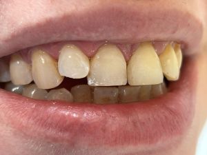 Dental Reimplant Trauma 5.jpg