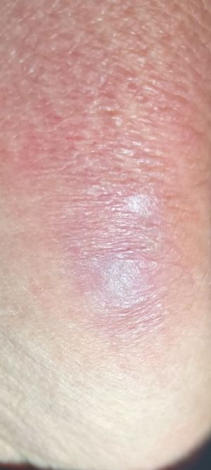 Case study diabetic decubitus 7.jpg