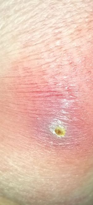 Case study diabetic decubitus 5.jpg