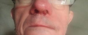 Nasal Tumor Benign CDS DMSO 03.jpg