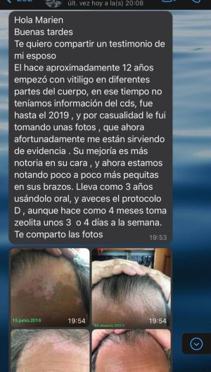 Vitiligo Husband Recovery.jpg