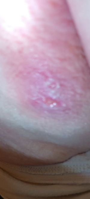 Case study diabetic decubitus 1.jpg