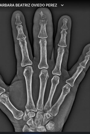DiabeticFinger After 01.jpg