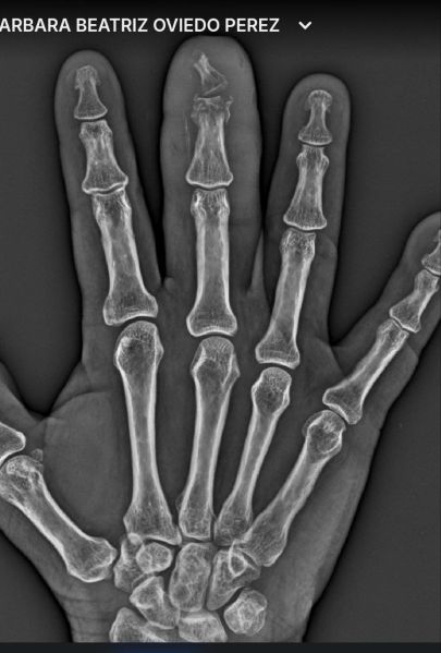 File:DiabeticFinger After 01.jpg