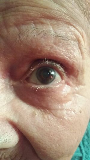Eye CDS DMSO Close After.jpg