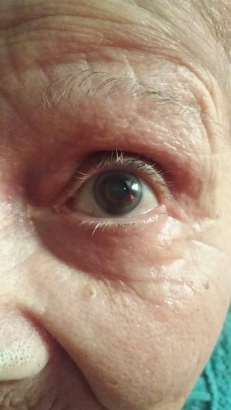 File:Eye CDS DMSO Close After.jpg