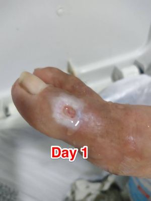 Case study chronic venous ulce 2.jpg
