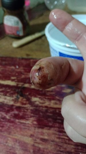 DiabeticFinger Process 06.jpg