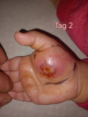 Case study toddler hand infect 3.jpg