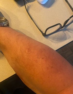 Brown Recluse Metal Implants 01.jpg