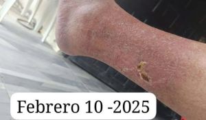 Diabetic Non Healing Wound CDS DMSO Moringa 02.jpg
