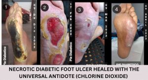 Necrotic Diabetic Foot Ulcer Healed CDS.jpg