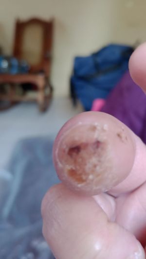 DiabeticFinger After 08.jpg