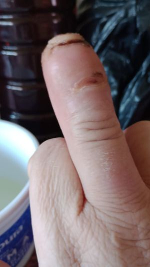 DiabeticFinger Process 02.jpg