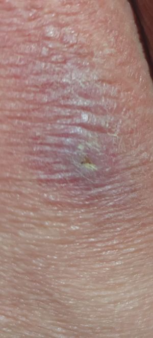 Case study diabetic decubitus 6.jpg