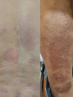 Psoriasis 15Years CD S 03.jpg