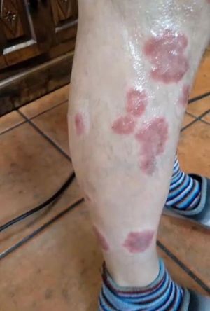 Case study brown recluse spide 1.jpg