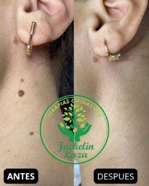 Testimonial Neck Fibromas Eliminated Without Surgery CDS 1.jpg
