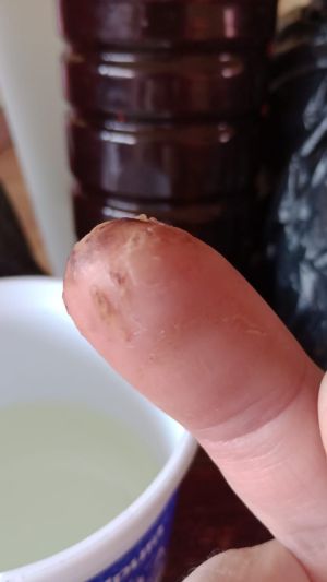 DiabeticFinger Before 07.jpg