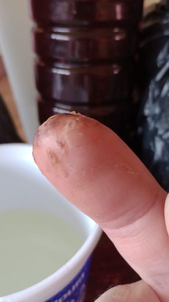 File:DiabeticFinger Before 07.jpg