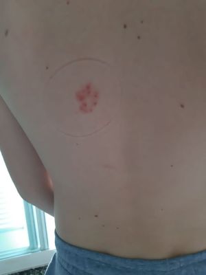 Case study herpes on childs ba 2.jpg