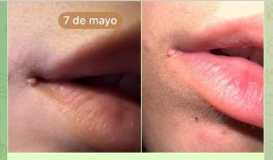 Case study hpv papilloma at li 1.jpg