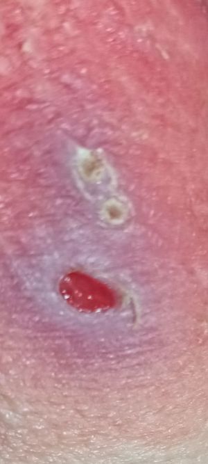 Case study diabetic decubitus 3.jpg