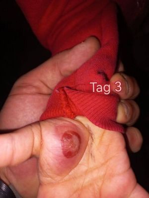 Case study toddler hand infect 4.jpg