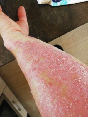 Neurodermatitis CDL Oct 2025.jpg