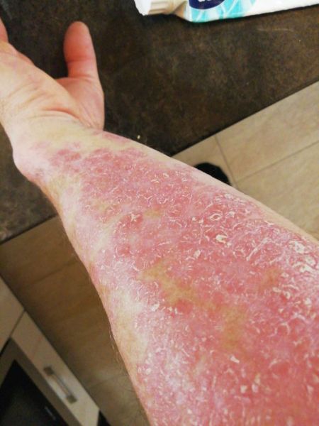 File:Neurodermatitis CDL Oct 2025.jpg