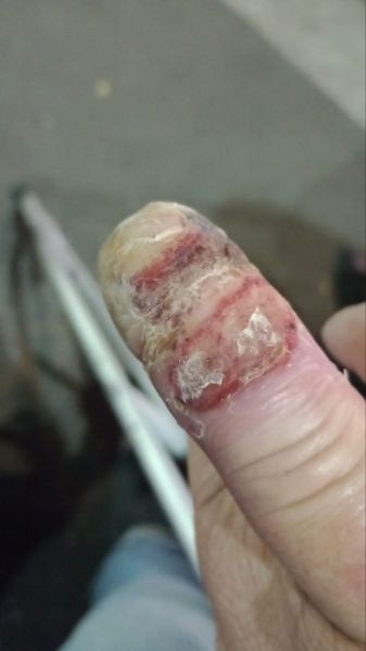 File:DiabeticFinger 3.jpg