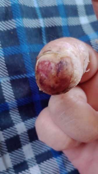 File:DiabeticFinger Before 01.jpg
