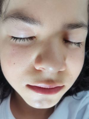Child Facial Dermatitis CDS 02.jpg