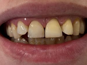 Dental Reimplant Trauma 6.jpg