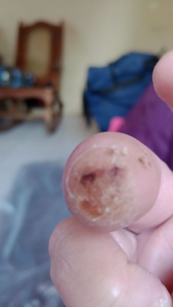 File:DiabeticFinger Process 14.jpg